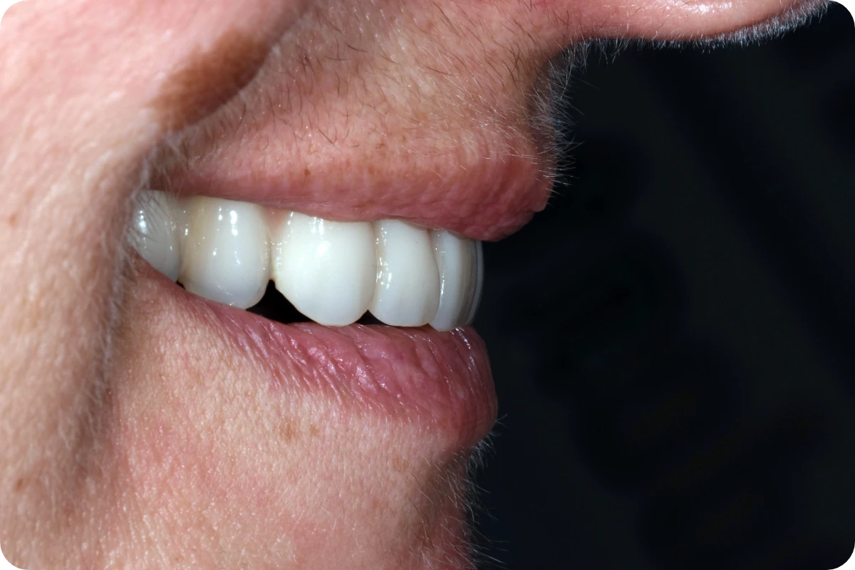 Studio Raschiotti Landing Rifarsi I Denti Carico Immediato Sorriso