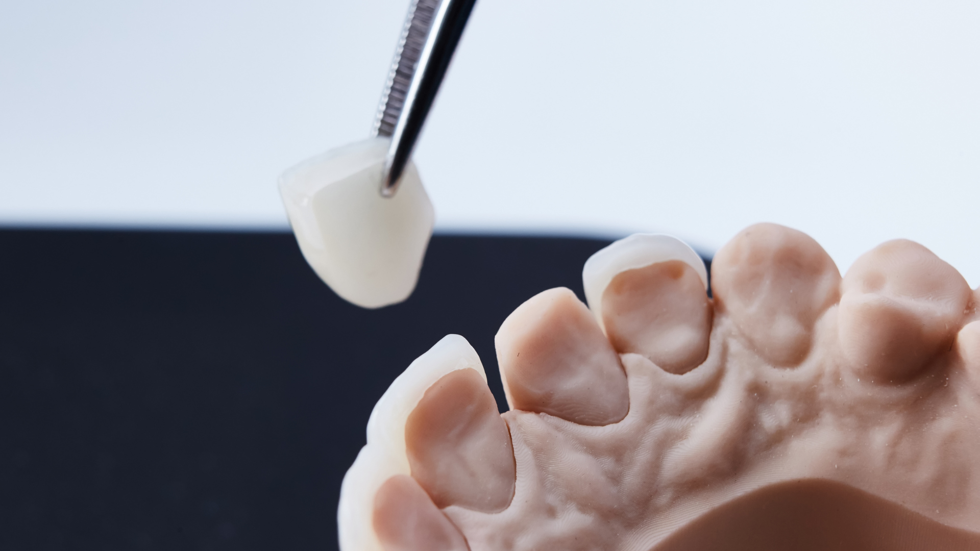 Le Faccette Dentali