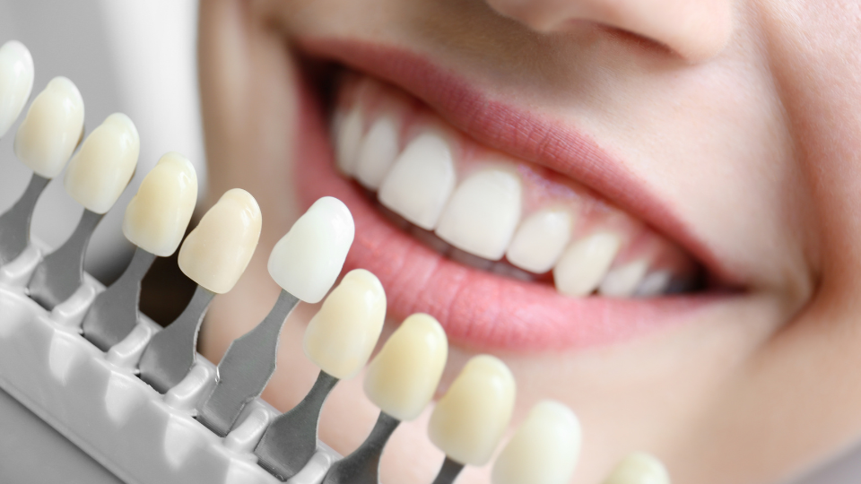Sbiancamento dentale
